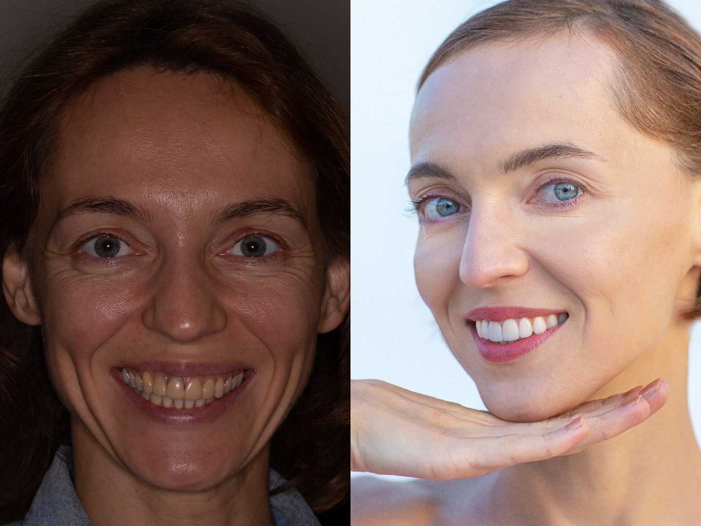 Porcelain veneers in Tustin, CA — before and after, upper arch case by Dr. Marta Rudat