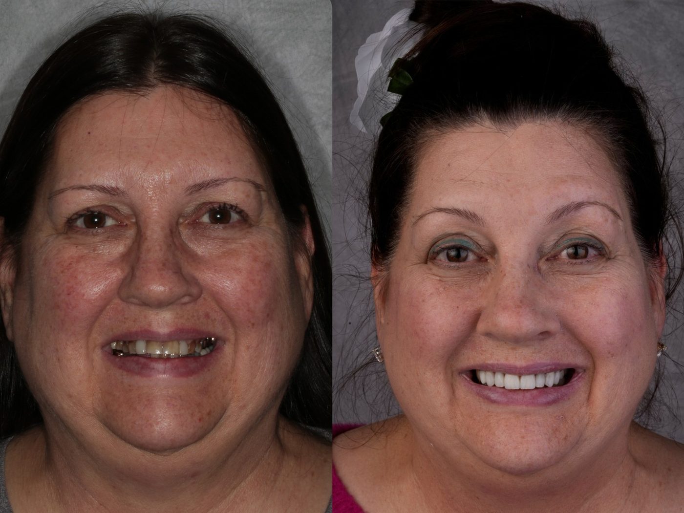 Full smile reconstruction in Tustin, CA — before and after by Dr. Marta Rudat