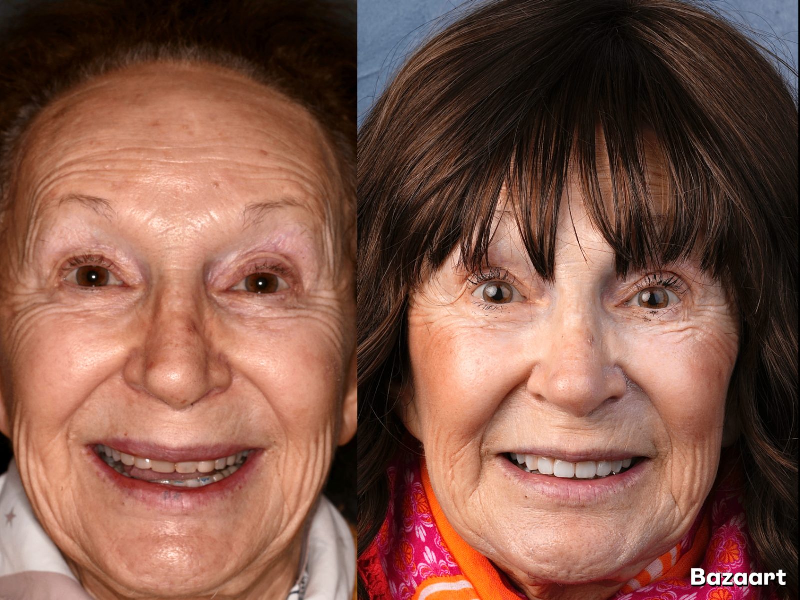Full smile makeover in Tustin, CA — before and after by Dr. Marta Rudat