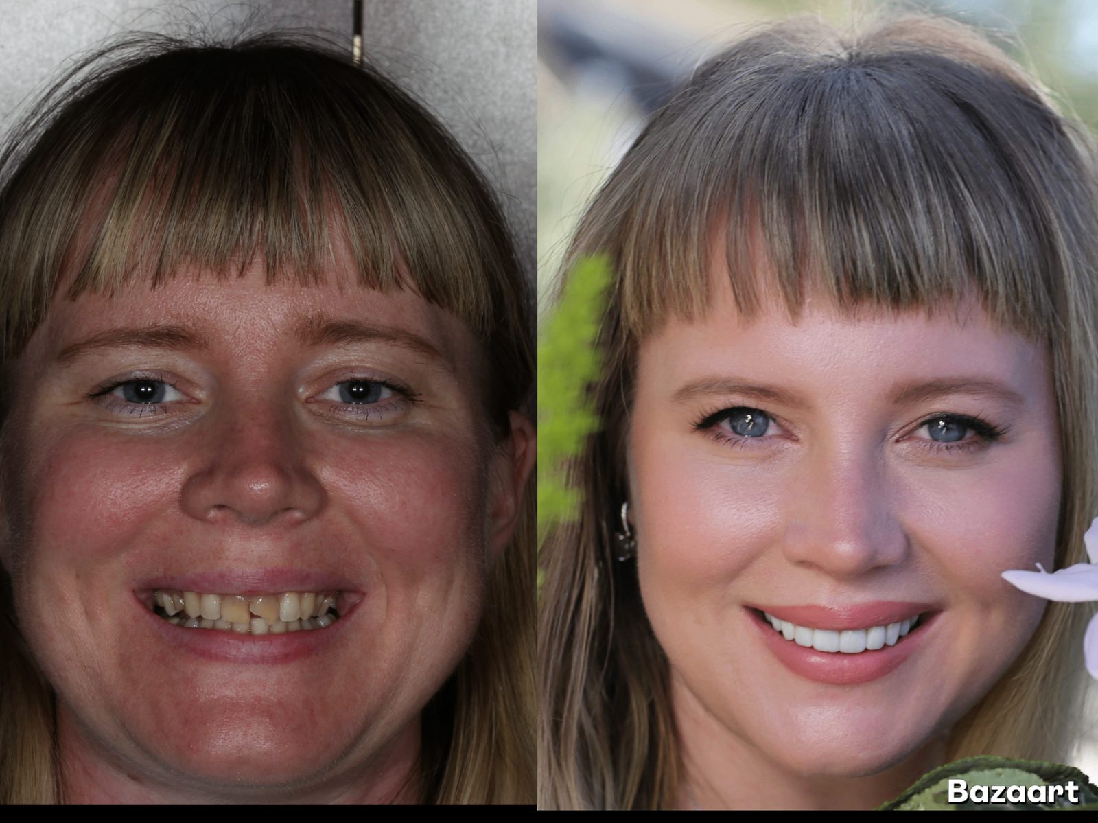 Full-mouth restoration in Tustin, CA — before and after by Dr. Marta Rudat